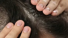 シャンプーは不要:どの家庭にもあるスパイスでフケとお別れしましょう